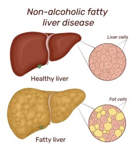 Non-alcoholic fatty liver disease