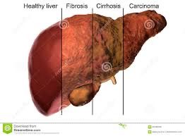 Stages of liver disease