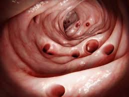 diverticulitis